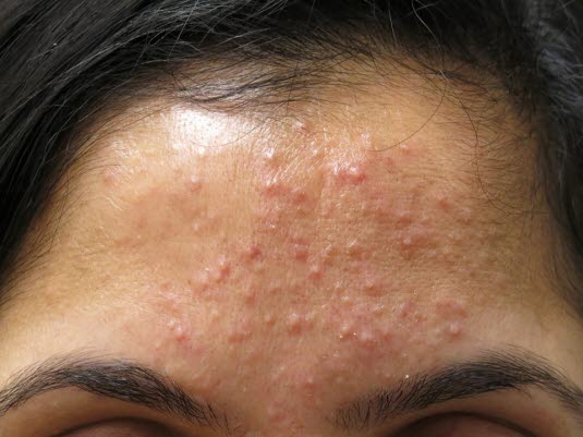 Acne papulopustulosa – gering bis mäßig ausgeprägt