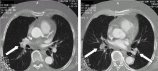 Lungenembolie - Spiral-CT