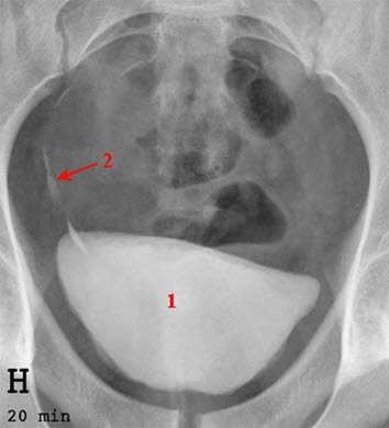 Urografie der Harnblase