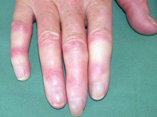 Raynaud-Syndrom