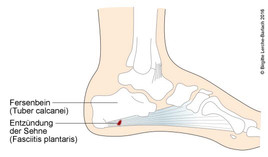 Plantaraponeurose, Seitenansicht