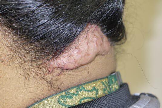 Folliculitis keloidalis nuchal 