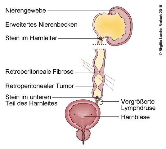 Hydronephrose