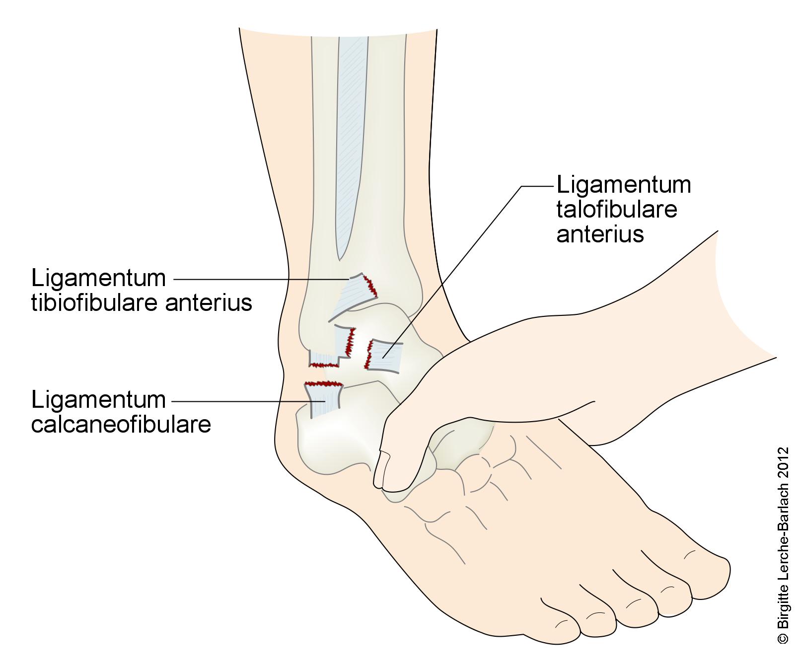 Sprunggelenk, Ruptur des Ligamentum talofibulare und calcaneofibulare