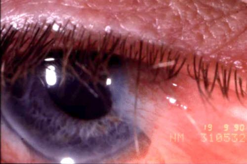 760-2-pterygium-markert.jpg