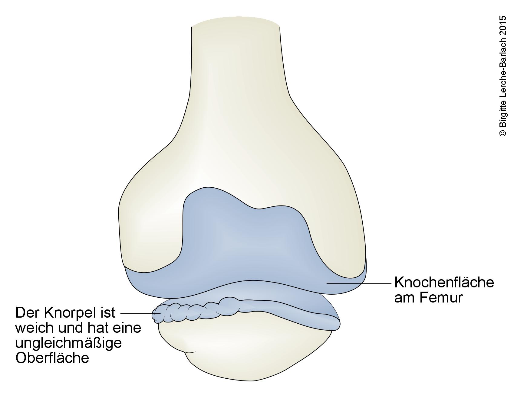 Chondromalazie, Patella.jpg