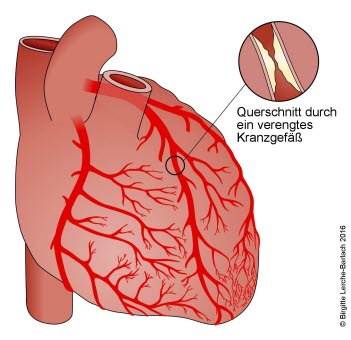 Verengtes Herzkranzgefäß bei koronarer Herzkrankheit