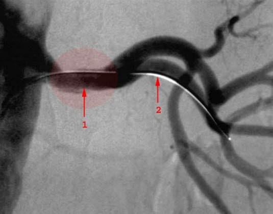 Nierenarterienstenose, nach der Behandlung