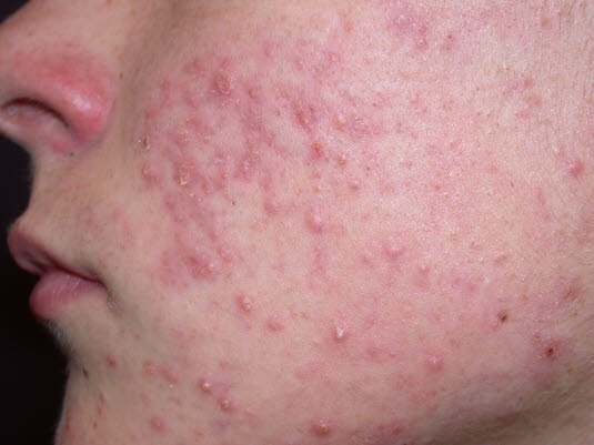 Acne papulopustulosa – mäßig ausgeprägt