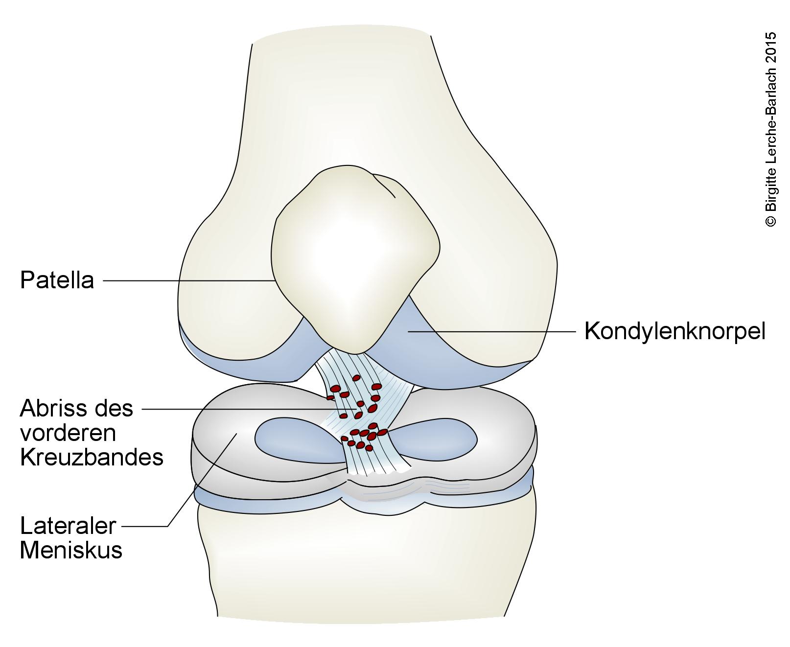 Knie, Ruptur aller Fasern im vorderen Kreuzband