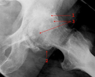 Koxarthrose, Röntgen, schwerwiegend