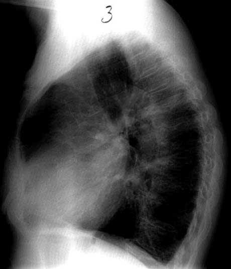 Cor pulmonale - seitlich