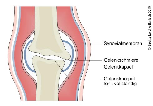 686 Arthrose_ Endstadium.jpg