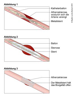 Ballondilatierung mit Stent-Einsatz bei verengtem Gefäß