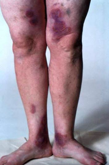 Erythema multiforme