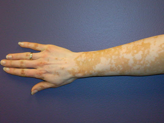 Die Vitiligo ist eine erworbene, scharf begrenzte Depigmentierung der Haut infolge eines vollständigen Verlusts der Melanozyten in dem betroffenen Bereich.