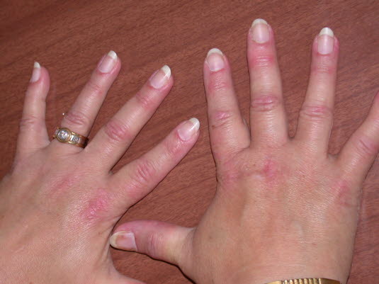 Eine Dermatomyositis betrifft Frauen doppelt so häufig wie Männer, und führt oft zu Nagelwurzelveränderungen mit u. a. periungualen Teleangiektasien.