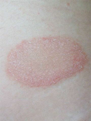 Pityriasis rosea: Primärmedaillon („Mutterfleck“)