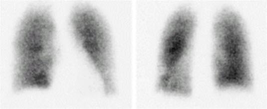 Lungenembolie - Ventilationsszintigrafie