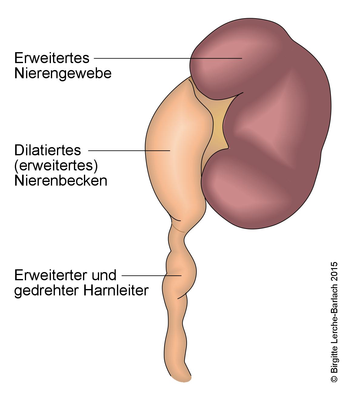 Hydronephrose