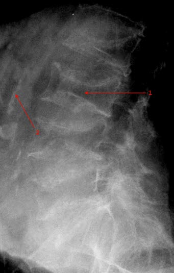 Osteoporose der LWS: verminderte Knochendichte und Deckplatteneinbrüche der Wirbelkörper