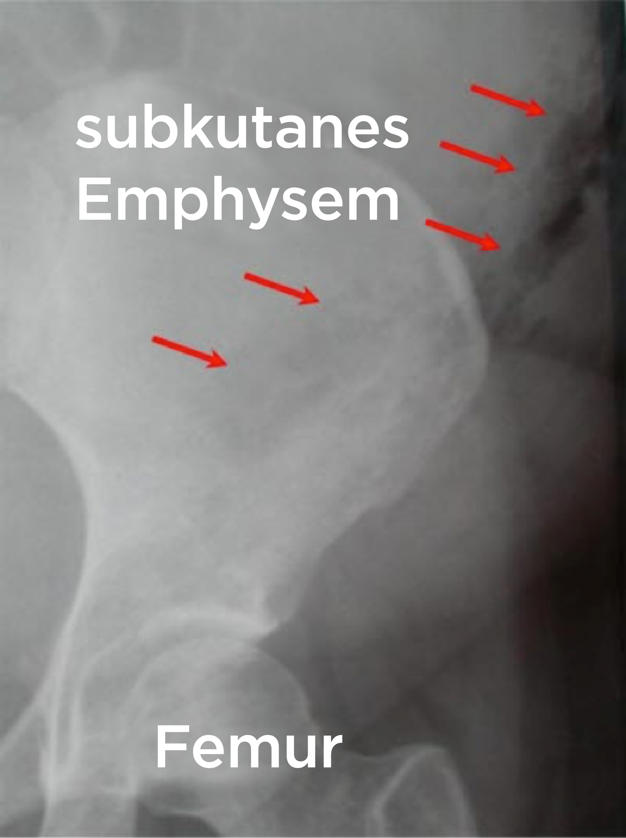 Subkutanes Emphysem bei nekrotisierender Fasziitis