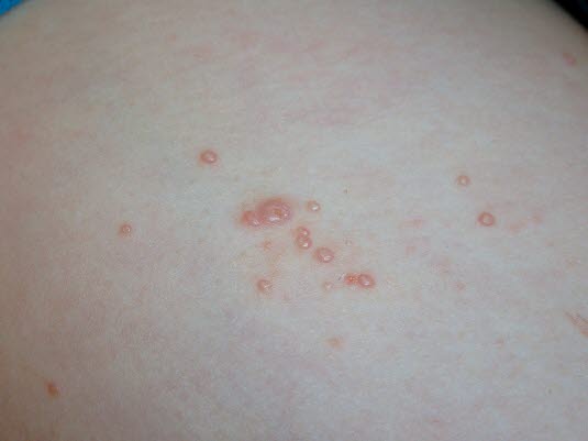 Dellwarzen/Mollusca contagiosa