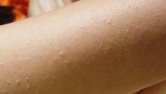 Keratosis pilaris ist eine sehr verbreitete Hautveränderung bei Kindern und Jugendlichen. Die Hauterscheinungen bilden sich spontan zurück.