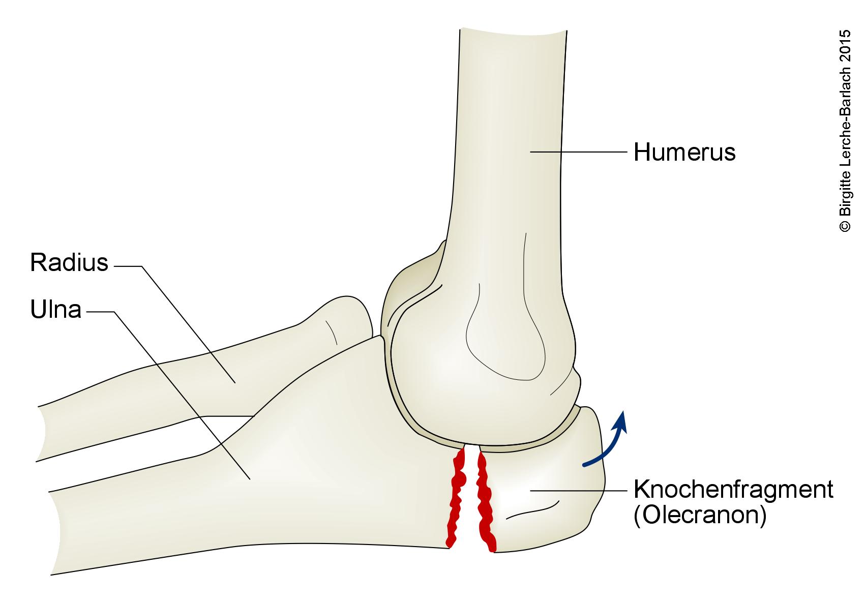 Ulnafraktur, durchlaufender Bruch