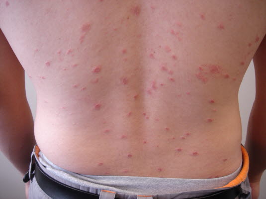 Pityriasis rosea. Am Körperstamm verläuft der längste Durchmesser der Ausschläge parallel zu den Rippen in Längsrichtung der Haut, was meist aus ein wenig Abstand einfach zu sehen ist.