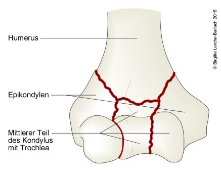 Humerus, transkondylaere Splitterfraktur