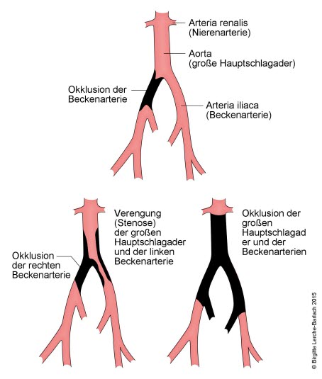 Thrombotische Erkrankungen der Iliaca-Arterien