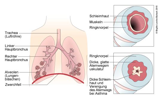 Trachea, Bronchien mit und ohne Konstriktion