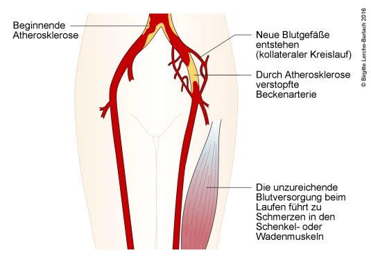 Claudicatio intermittens