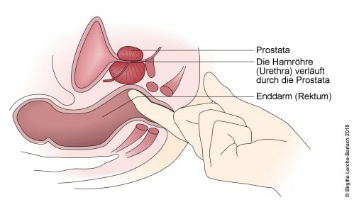 Prostatauntersuchung (Exploration)