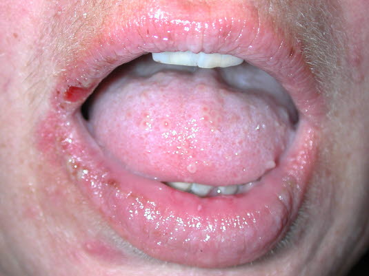 Pemphigus vulgaris