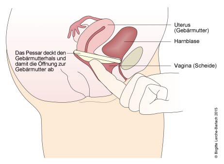 108 Pessar als Verhütungsmittel.jpg