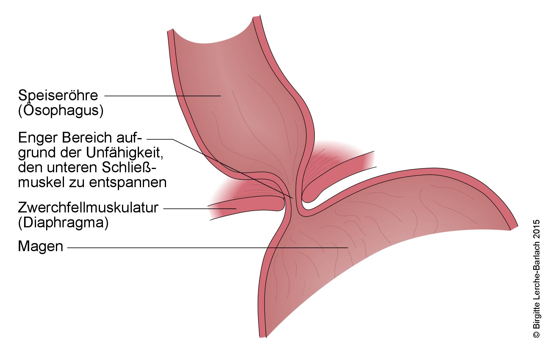 Achalasie