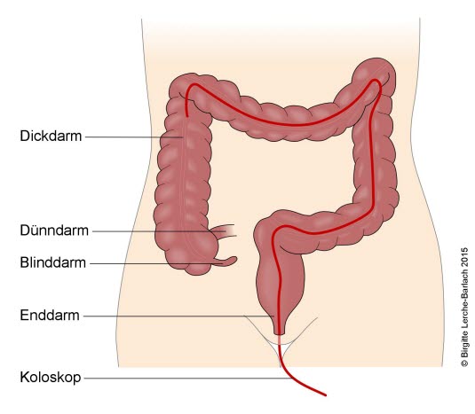 Koloskopie
