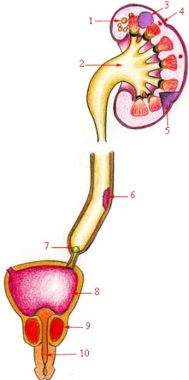 Ursachen für Hämaturie. Nierenzysten (1), Hydronephrose (2), Nierenkarzinom (3), Gefäßanomalien (4), Niereninfarkt (5), Urothelialer Tumor im Harnleiter (6), Harnstein (7), Harnwegsinfektion (8), Prostataerkrankung (9), Harnröhrenerkrankung (10)