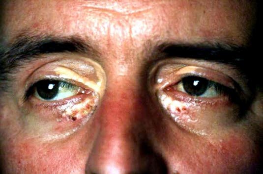 Die Konsistenz eines Xanthelasma palpebrarum kann weich bis hart sein. Es tritt häufig symmetrisch im Bereich der Augenlider meistens nasal auf. 