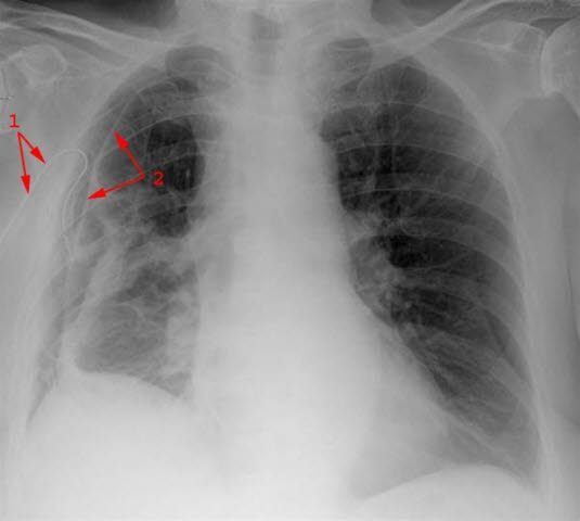 Röntgen des Pneumothorax mit eingesetzter Drainage re. Seite 