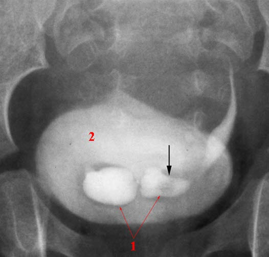 Ureterozele (Urografie)