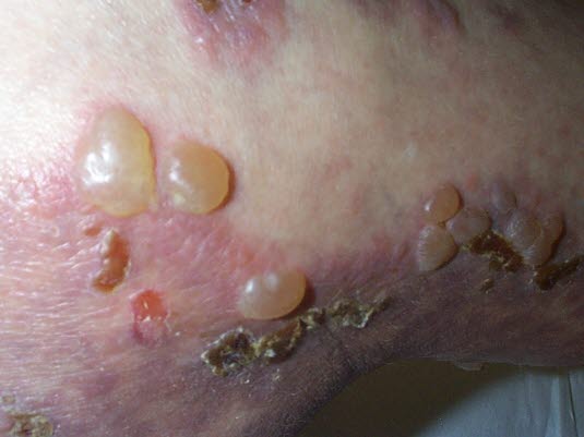 Bullöses Pemphigoid