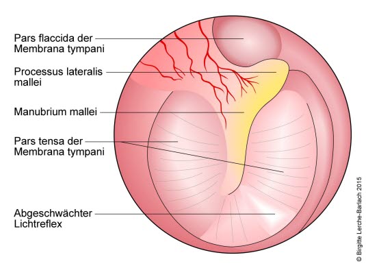 Ausbuchtung im Trommelfell