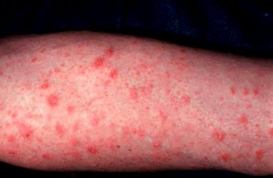 Pityriasis rosea: Exanthem aus kleineren, schuppenden Erythemen an proximalen Extremitäten wenige Wochen nach Primärmedaillon