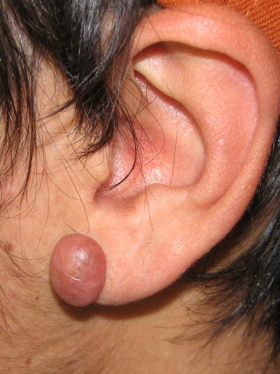 Keloid am Ohrläppchen