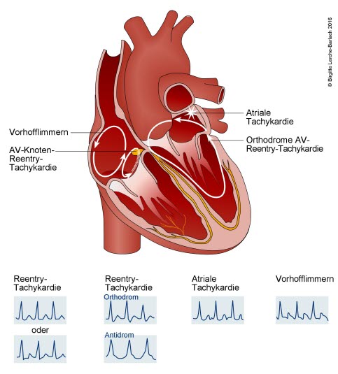 Hauptmechanismen und typisches EKG bei supraventrikulärer Tachykardie