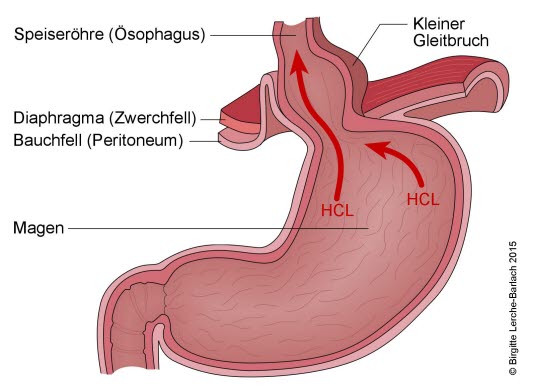 Schlaffer Schließmuskel mit Säurereflux (+ Hiatushernie)