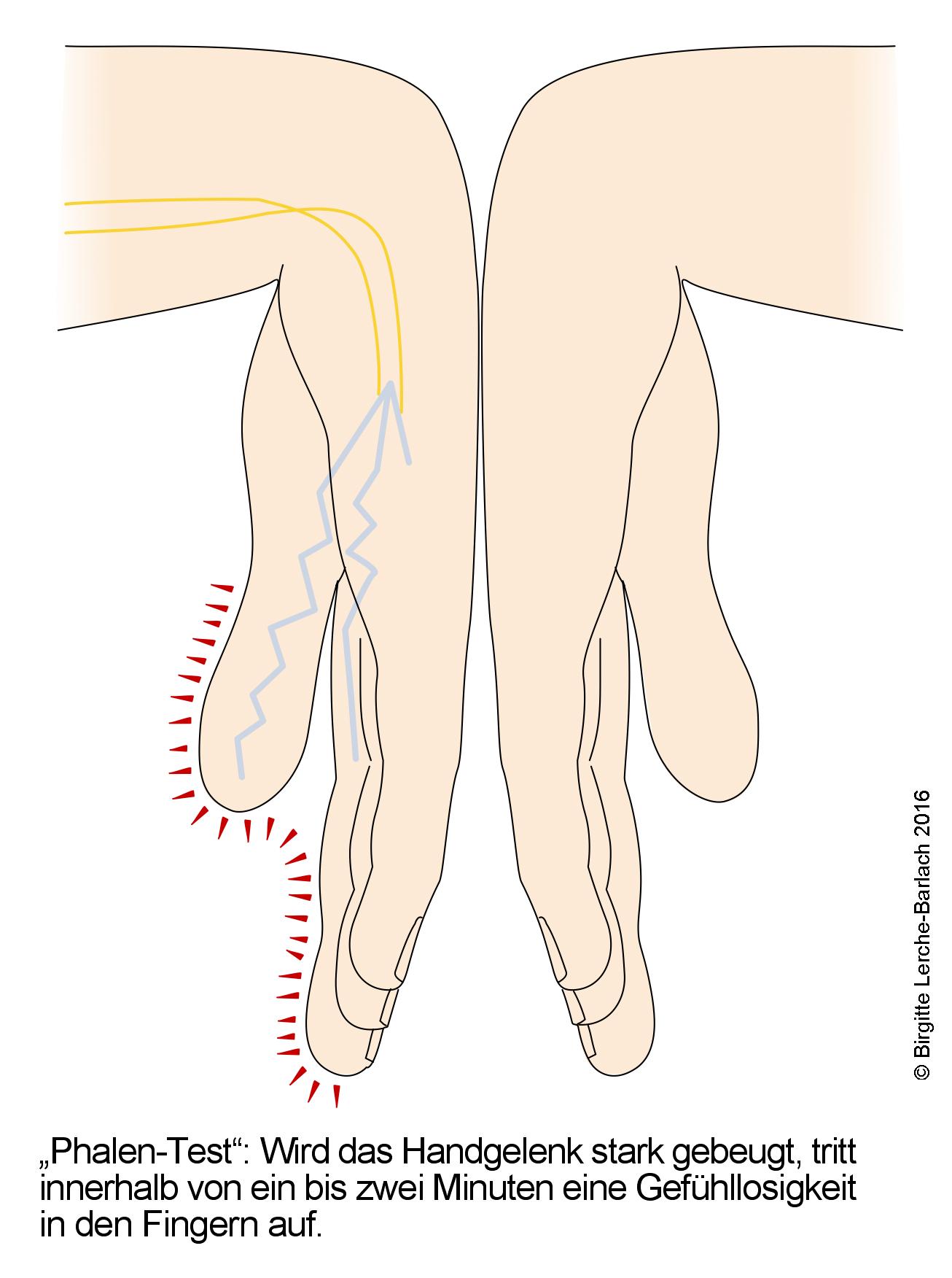 Phalen-Test.jpg